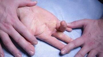 Контрактура Дюпюїтрена – не звичайна проблема. Все, що потрібно знати!